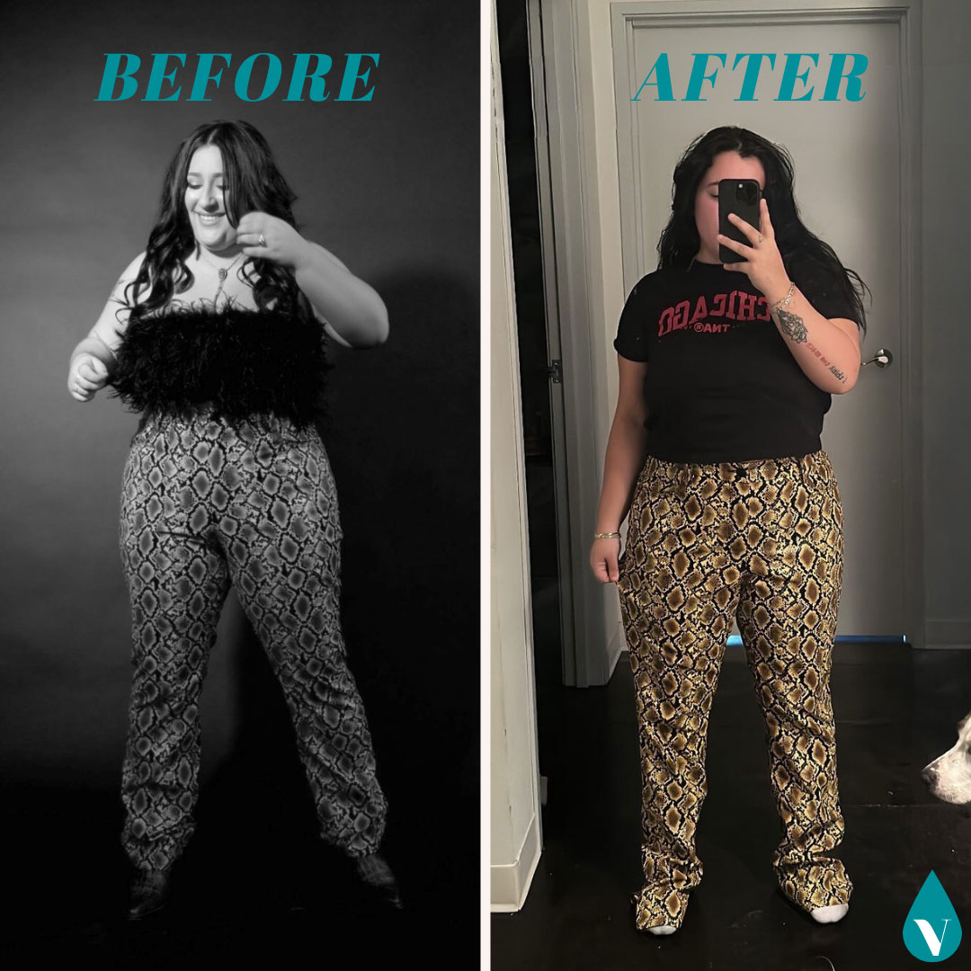 Before and After Semaglutide Weight Loss