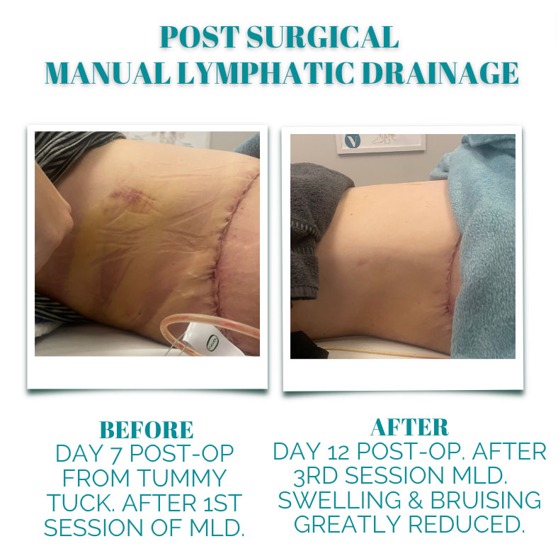 MLD Post-Surgery Before & After photo