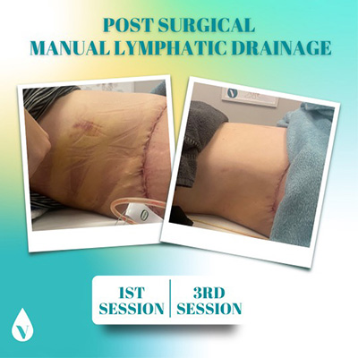 Post-Surgical-Manual-Lymphatic-Drainage-Befoer-and-After